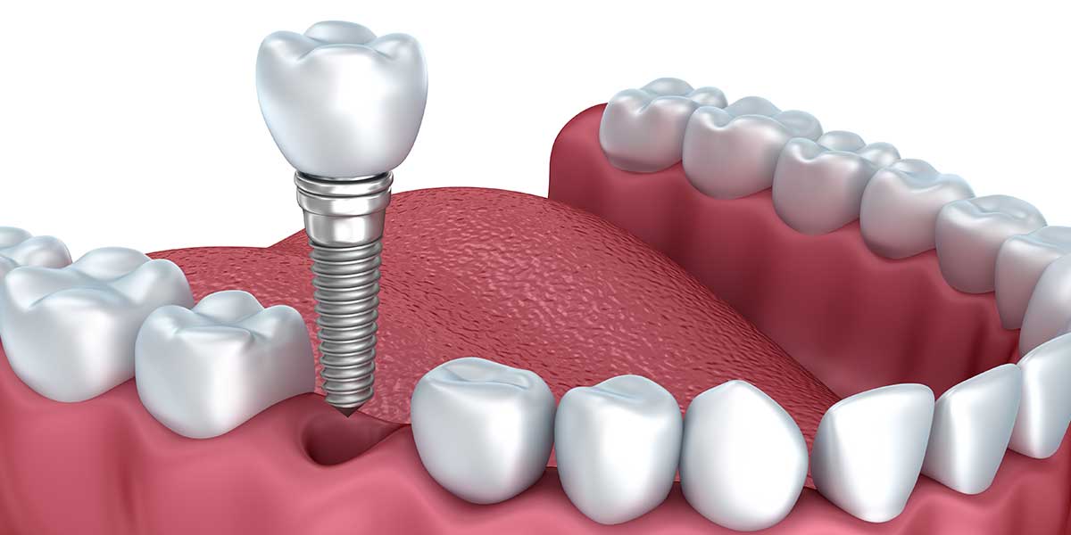 Dental Implants in Century City